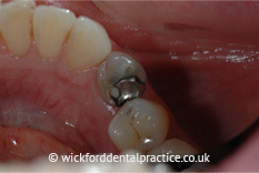 Amalgam Removals Before